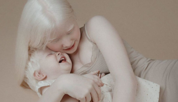 Сестри з альбінізмом зачаровують світ своєю красою (фото).